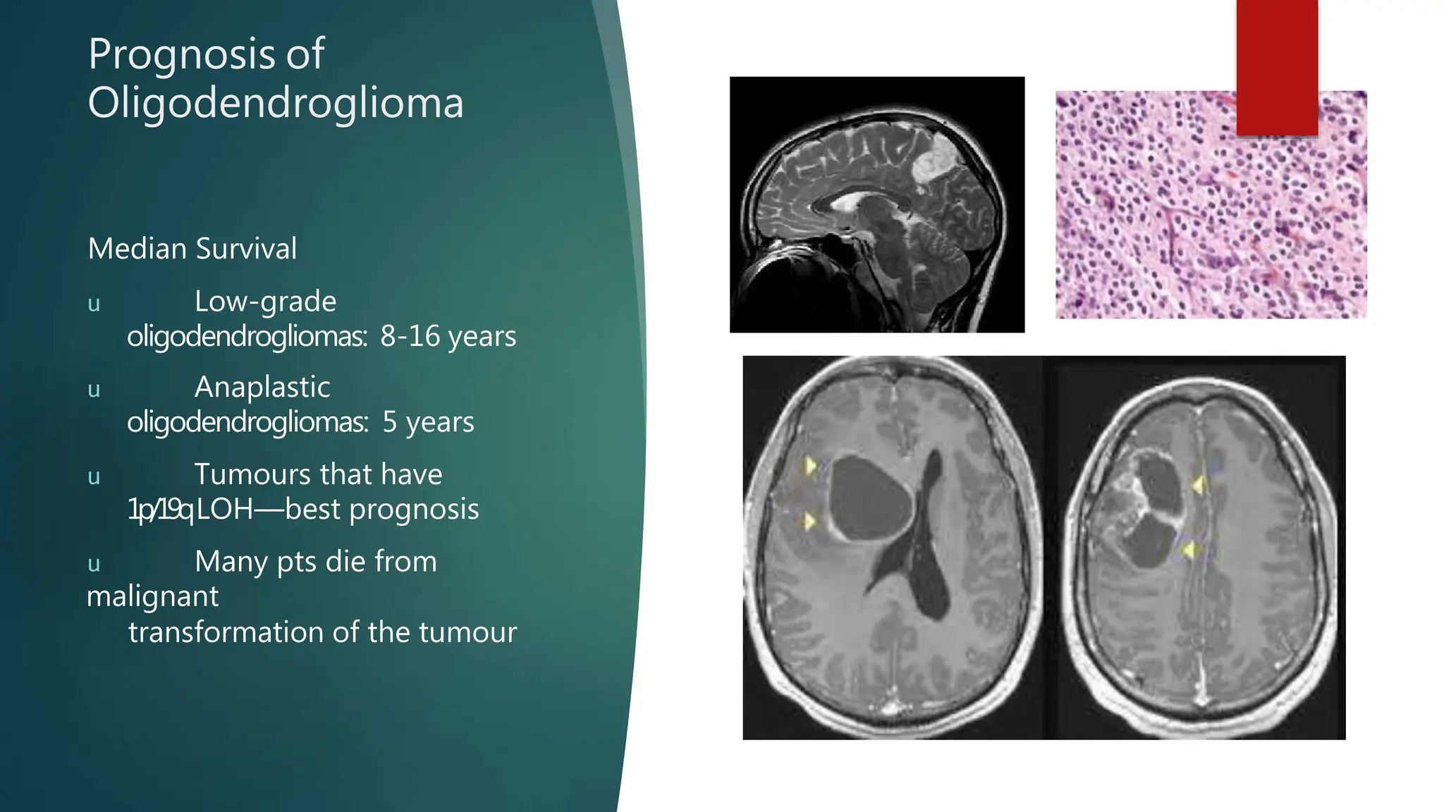 brain tumors-.power point brain diseases | PPTX