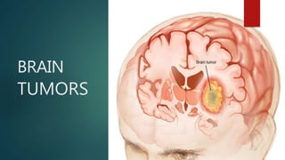 brain tumors-.power point brain diseases | PPTX