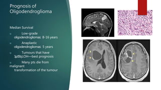 Prognosis of
Oligodendroglioma
Median Survival
u Low-grade
oligodendrogliomas: 8-16 years
u Anaplastic
oligodendrogliomas: 5 years
u Tumours that have
1p/19qLOH—best prognosis
u Many pts die from
malignant
transformation of the tumour
 