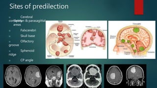 Sites of predilection
u Cerebral
convexity
(Sylvian & parasagittal
areas
u Falxcerebri
u Skull base
u Olfactory
groove
u Sphenoid
ridge
u CP angle
u
Tuberculumsella
 