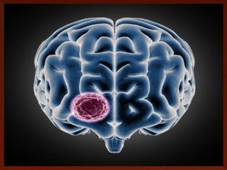 Brain Tumors .pptx