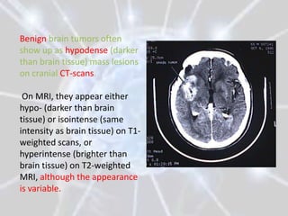 Benign brain tumors often
show up as hypodense (darker
than brain tissue) mass lesions
on cranial CT-scans.

 On MRI, they appear either
hypo- (darker than brain
tissue) or isointense (same
intensity as brain tissue) on T1-
weighted scans, or
hyperintense (brighter than
brain tissue) on T2-weighted
MRI, although the appearance
is variable.
 