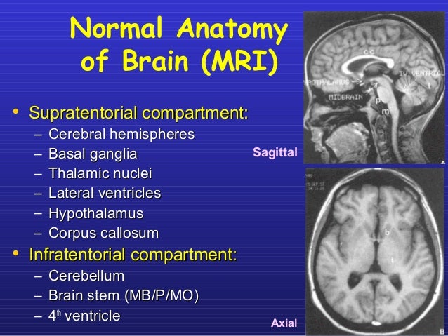 Types Of Brain Stem Tumors