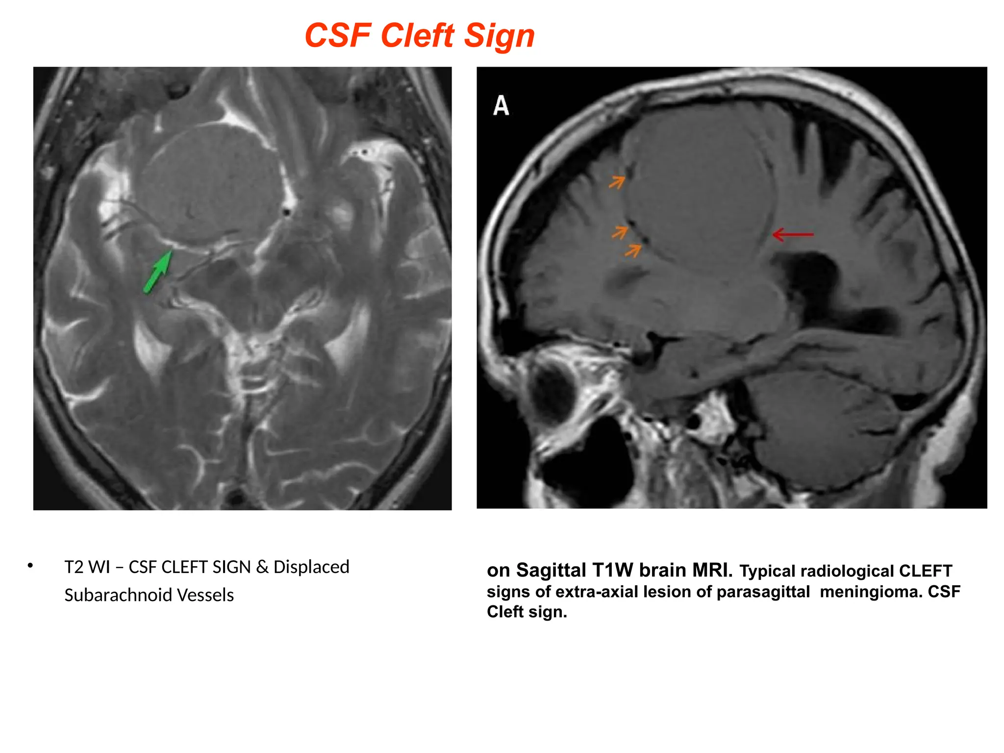 • T2 WI – CSF CLEFT SIGN & Displaced
Subarachnoid Vessels
on Sagittal T1W brain MRI. Typical radiological CLEFT
signs of extra-axial lesion of parasagittal meningioma. CSF
Cleft sign.
CSF Cleft Sign
 