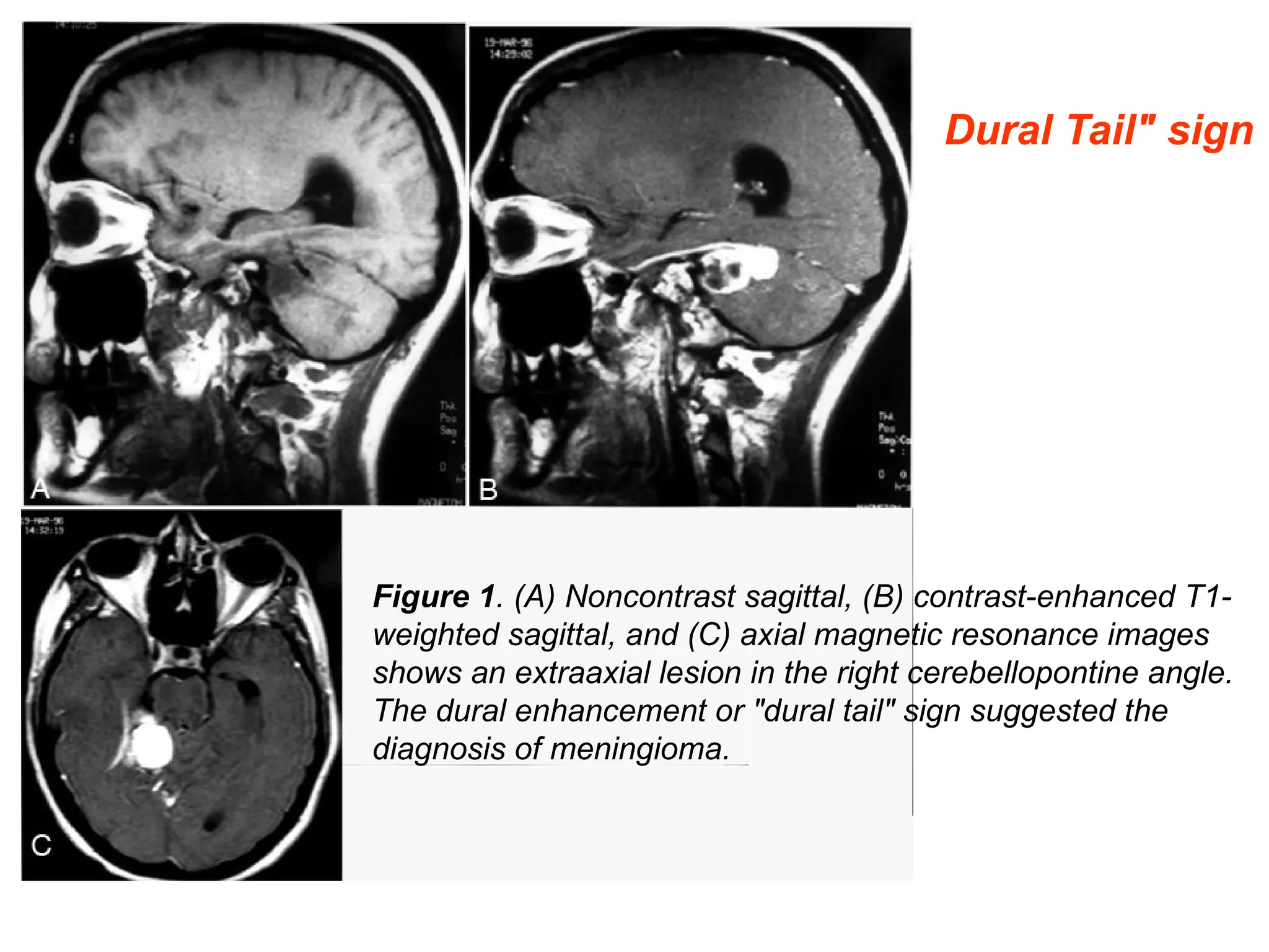 Figure 1. (A) Noncontrast sagittal, (B) contrast-enhanced T1-
weighted sagittal, and (C) axial magnetic resonance images
shows an extraaxial lesion in the right cerebellopontine angle.
The dural enhancement or "dural tail" sign suggested the
diagnosis of meningioma.
Dural Tail" sign
 