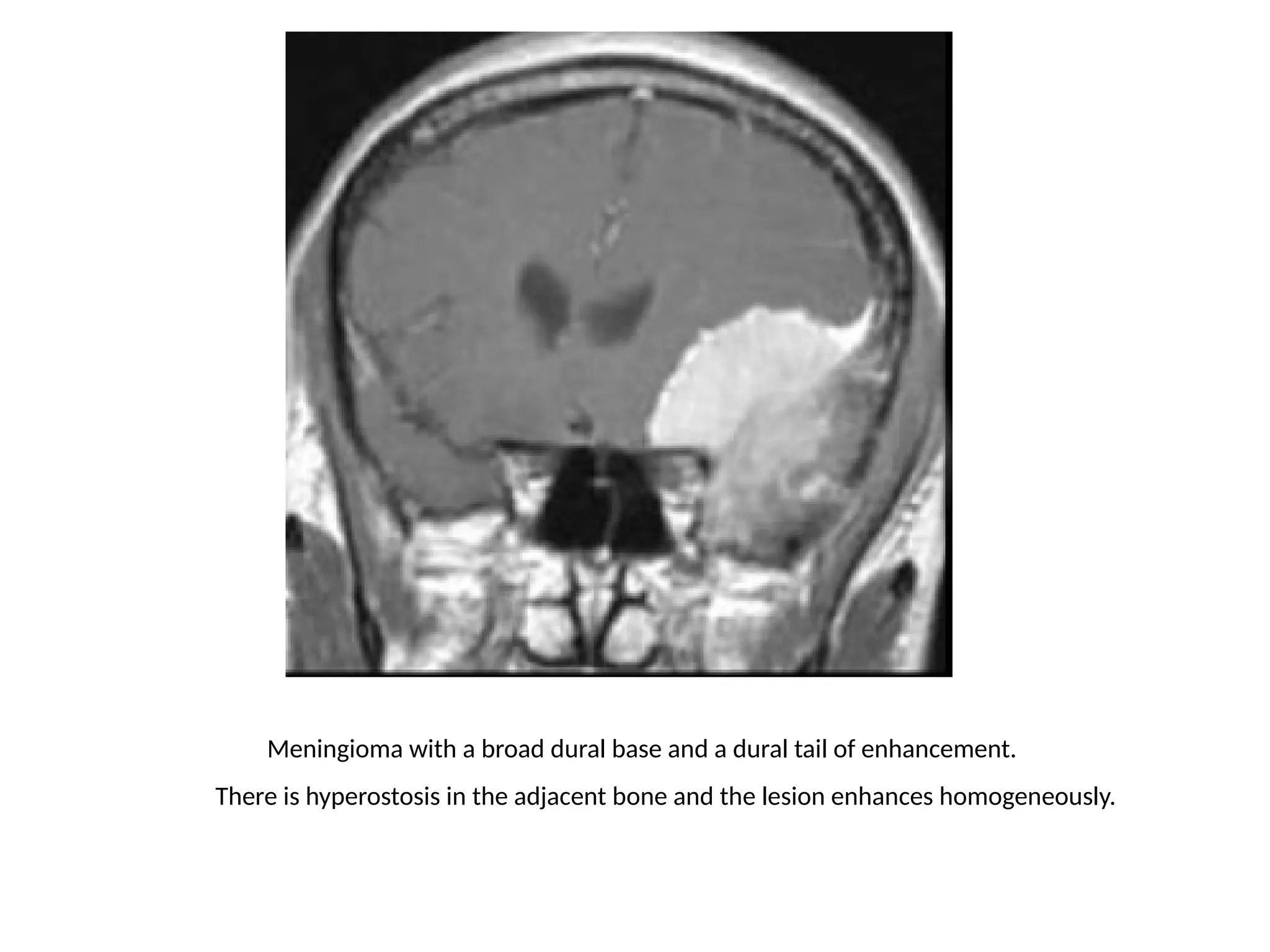 Meningioma with a broad dural base and a dural tail of enhancement.
There is hyperostosis in the adjacent bone and the lesion enhances homogeneously.
Extra-axial tumors are not derived from brain tissue and do not
have a blood-brain-barrier, so most of them enhance
homogeneously.
 