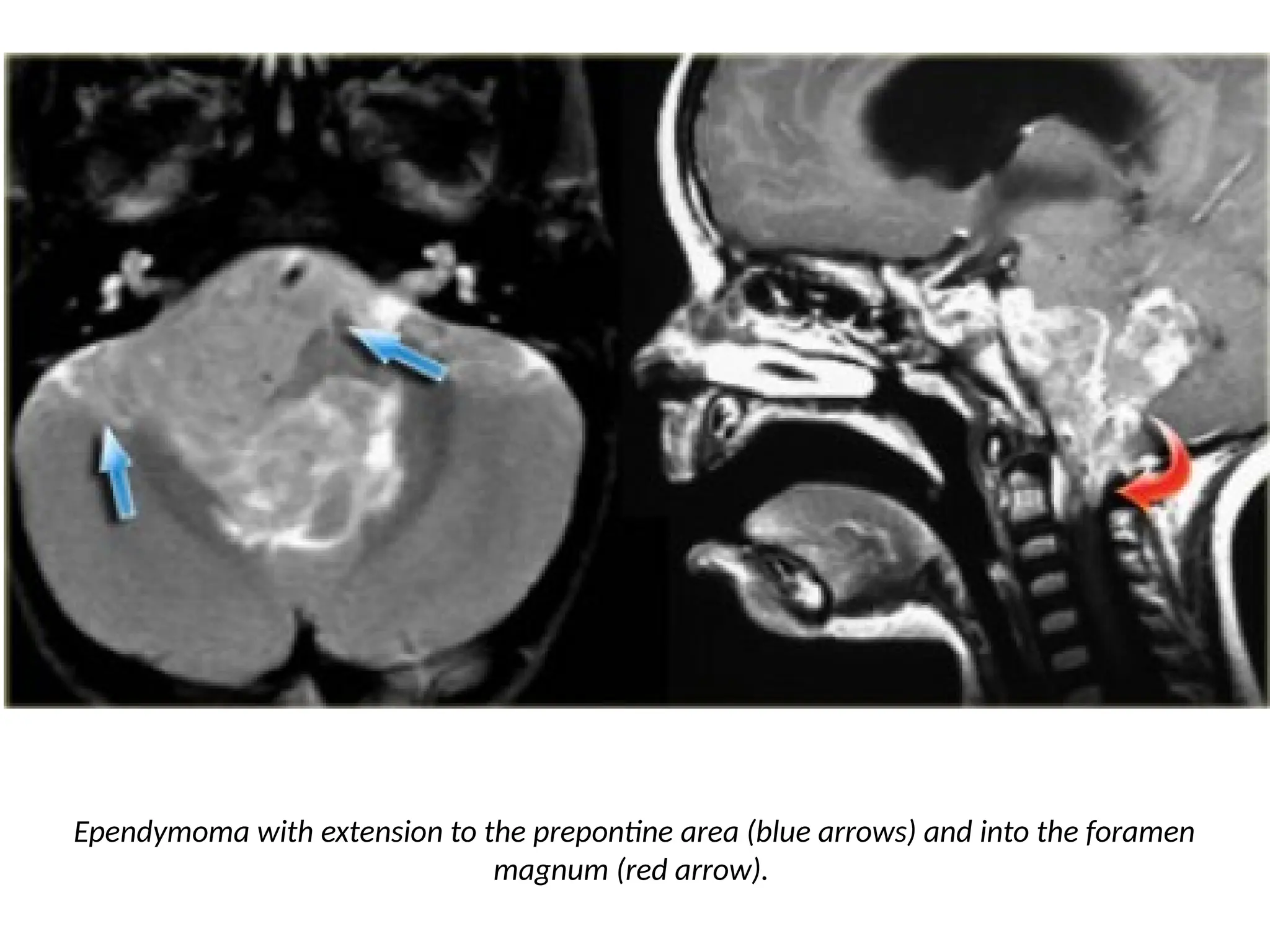 Ependymoma with extension to the prepontine area (blue arrows) and into the foramen
magnum (red arrow).
 