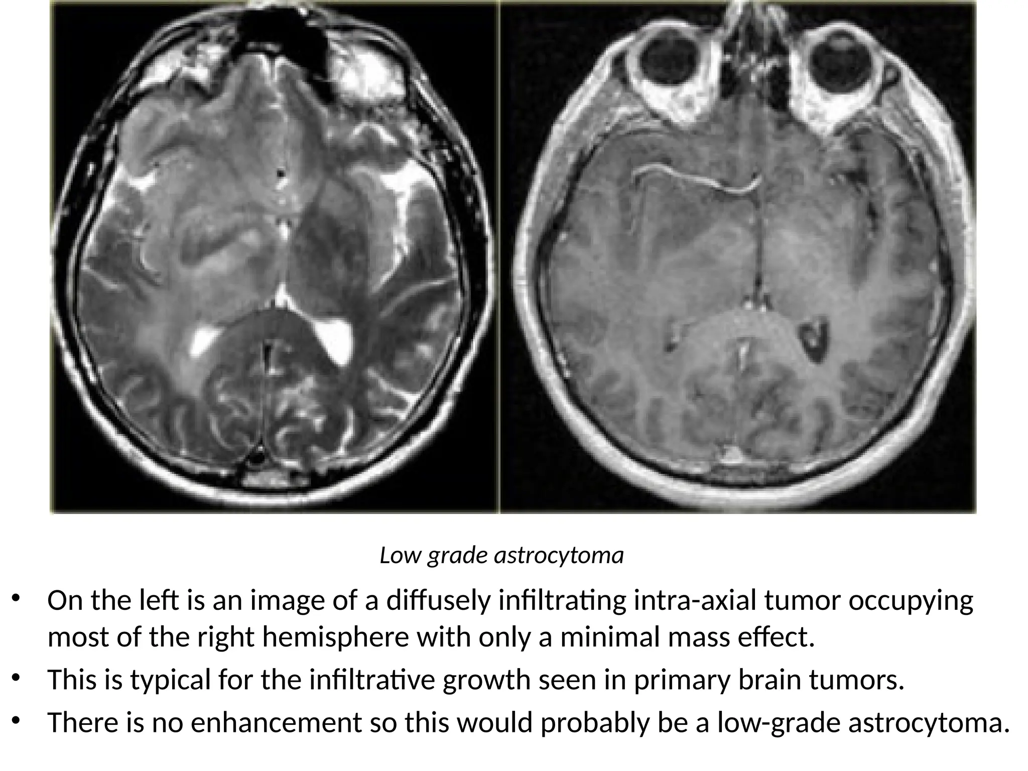 • On the left is an image of a diffusely infiltrating intra-axial tumor occupying
most of the right hemisphere with only a minimal mass effect.
• This is typical for the infiltrative growth seen in primary brain tumors.
• There is no enhancement so this would probably be a low-grade astrocytoma.
Low grade astrocytoma
 