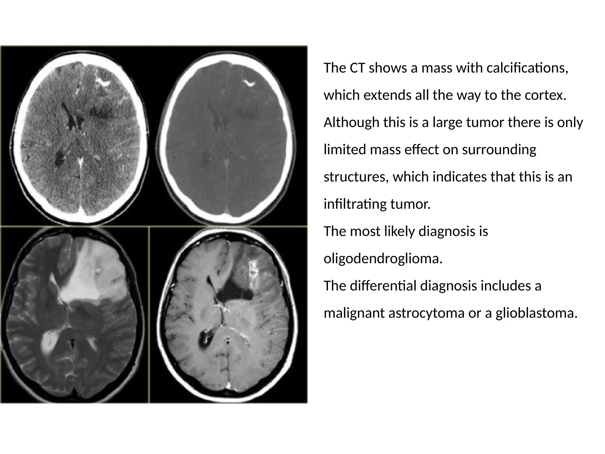 The CT shows a mass with calcifications,
which extends all the way to the cortex.
Although this is a large tumor there is only
limited mass effect on surrounding
structures, which indicates that this is an
infiltrating tumor.
The most likely diagnosis is
oligodendroglioma.
The differential diagnosis includes a
malignant astrocytoma or a glioblastoma.
 