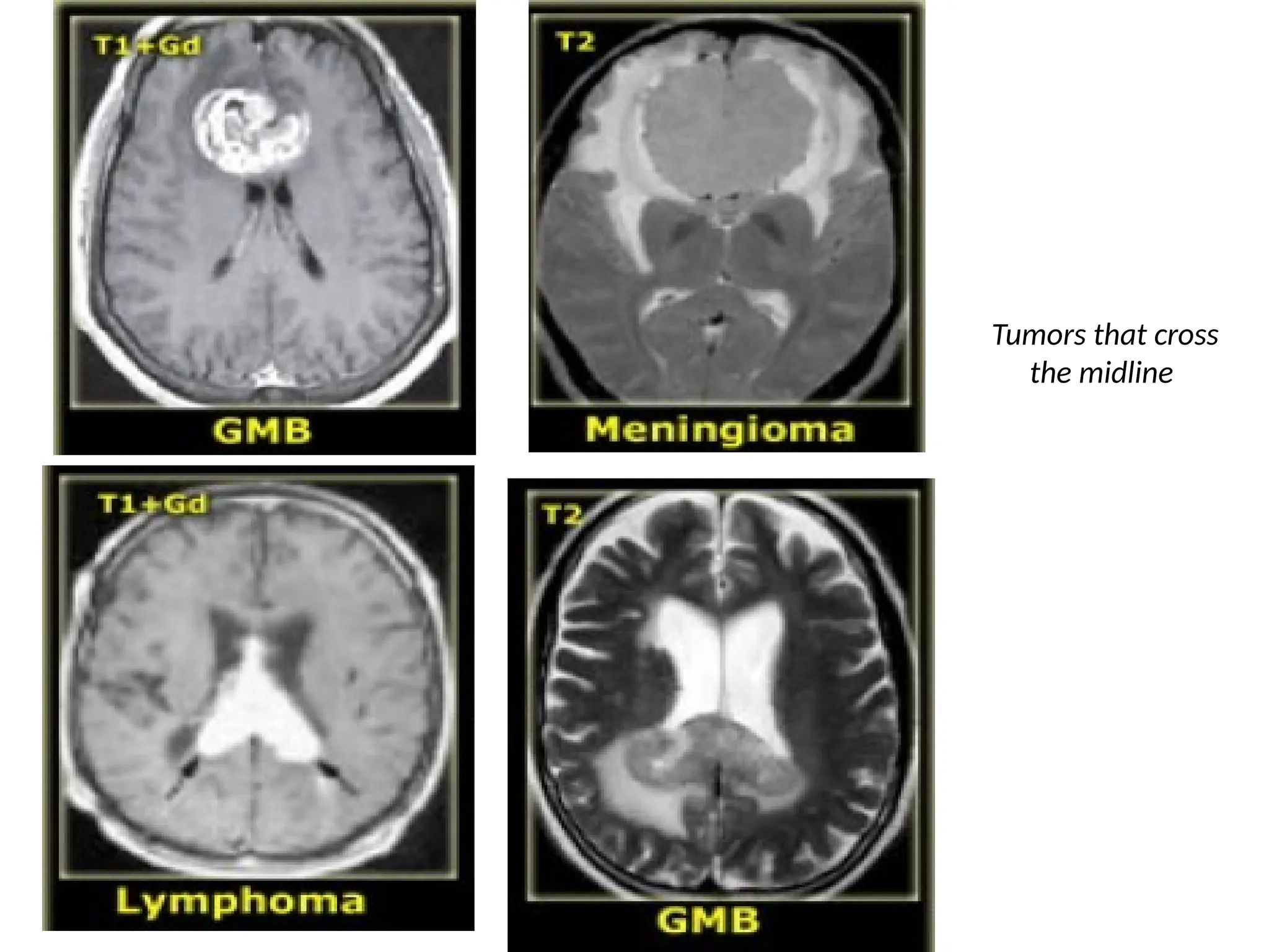 Tumors that cross
the midline
 