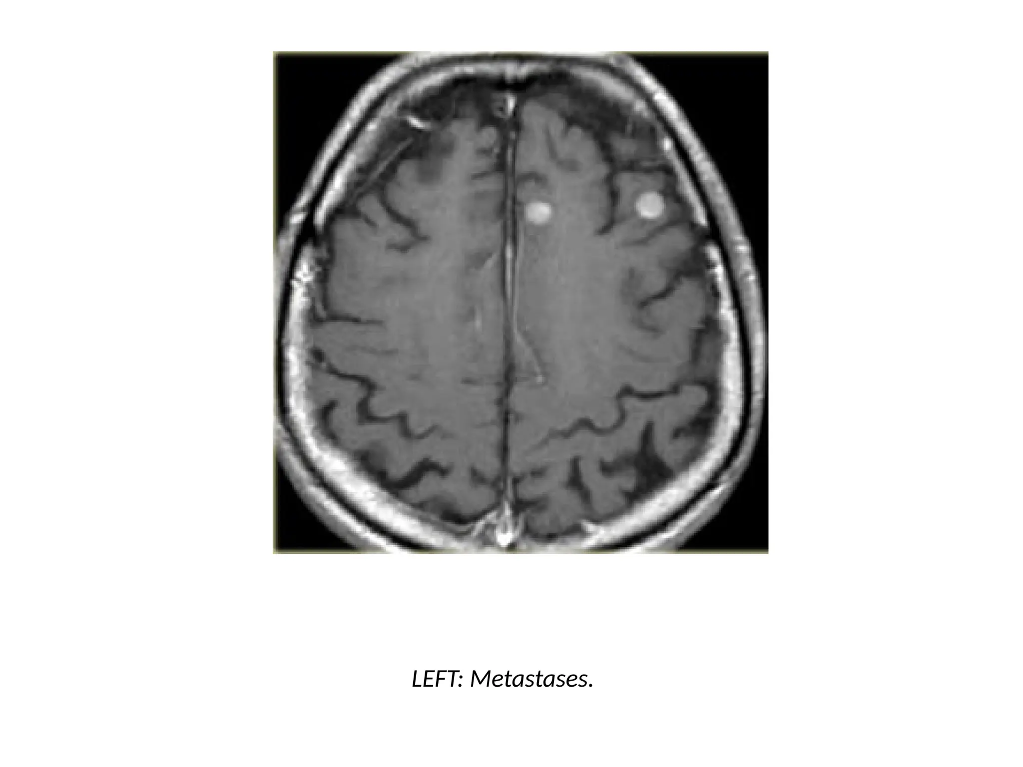 LEFT: Metastases.
 