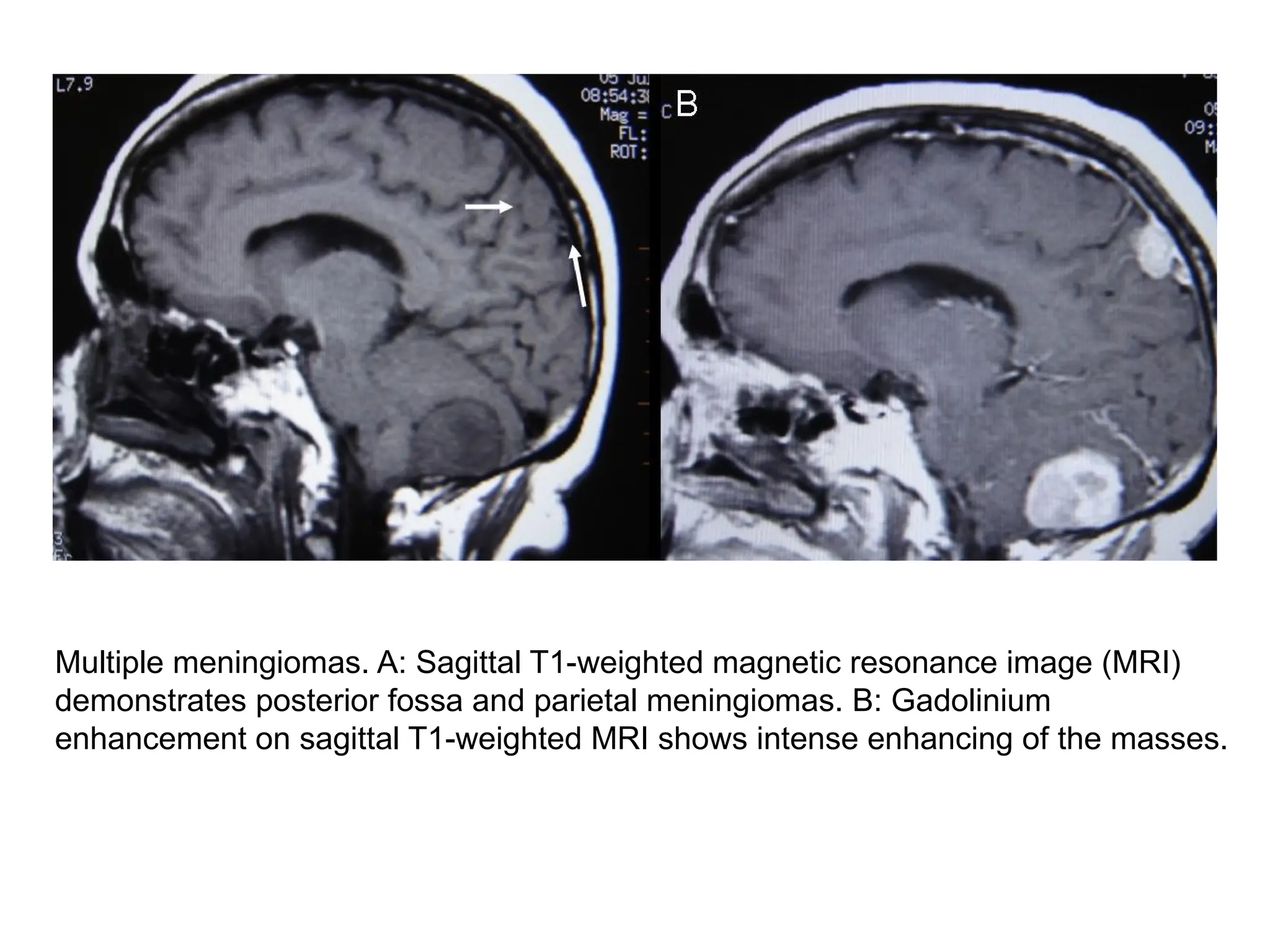 Multiple meningiomas. A: Sagittal T1-weighted magnetic resonance image (MRI)
demonstrates posterior fossa and parietal meningiomas. B: Gadolinium
enhancement on sagittal T1-weighted MRI shows intense enhancing of the masses.
 