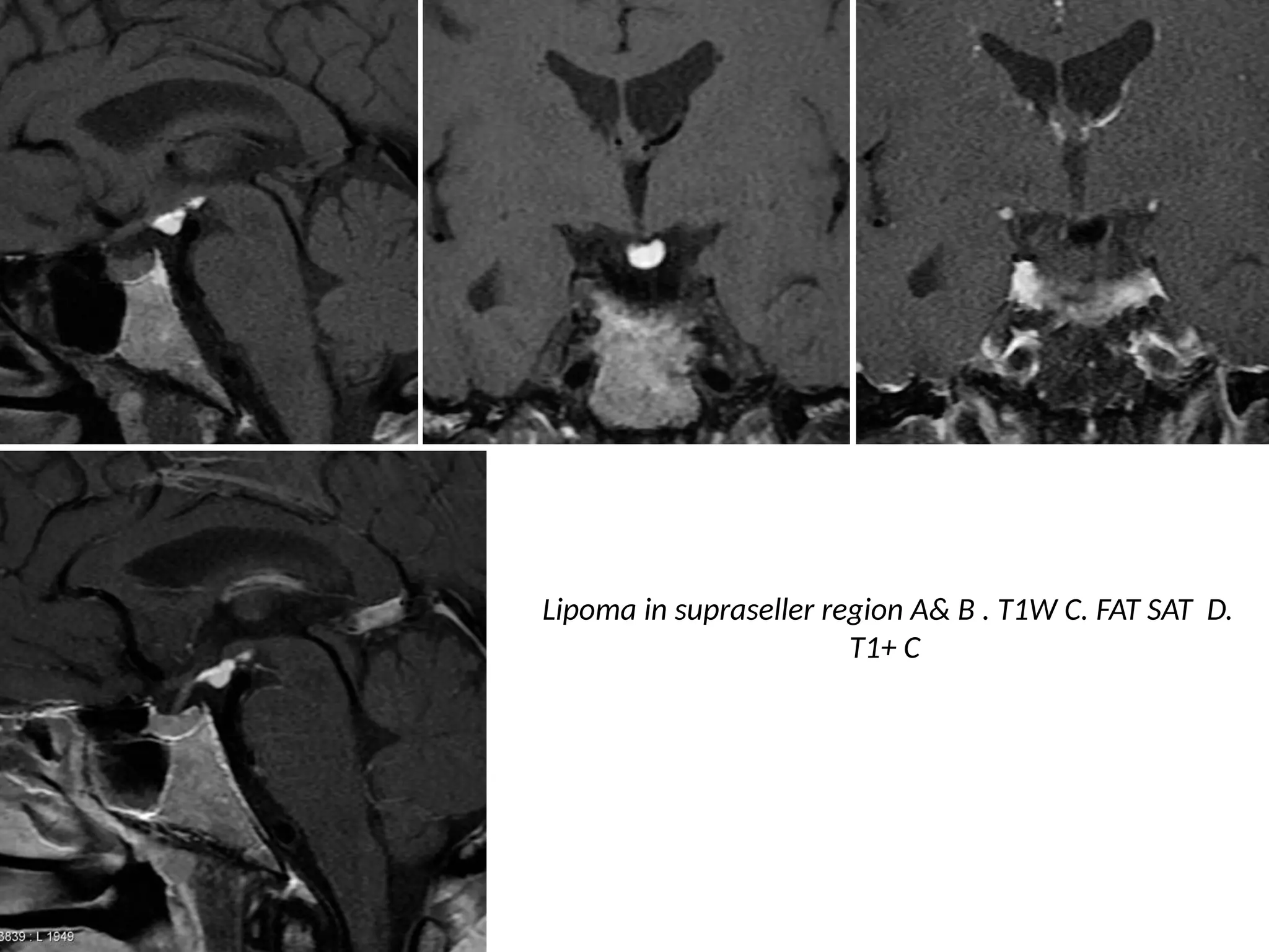 Lipoma in supraseller region A& B . T1W C. FAT SAT D.
T1+ C
 