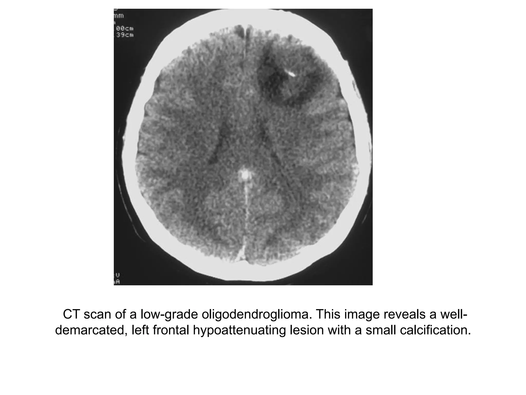 CT scan of a low-grade oligodendroglioma. This image reveals a well-
demarcated, left frontal hypoattenuating lesion with a small calcification.
 