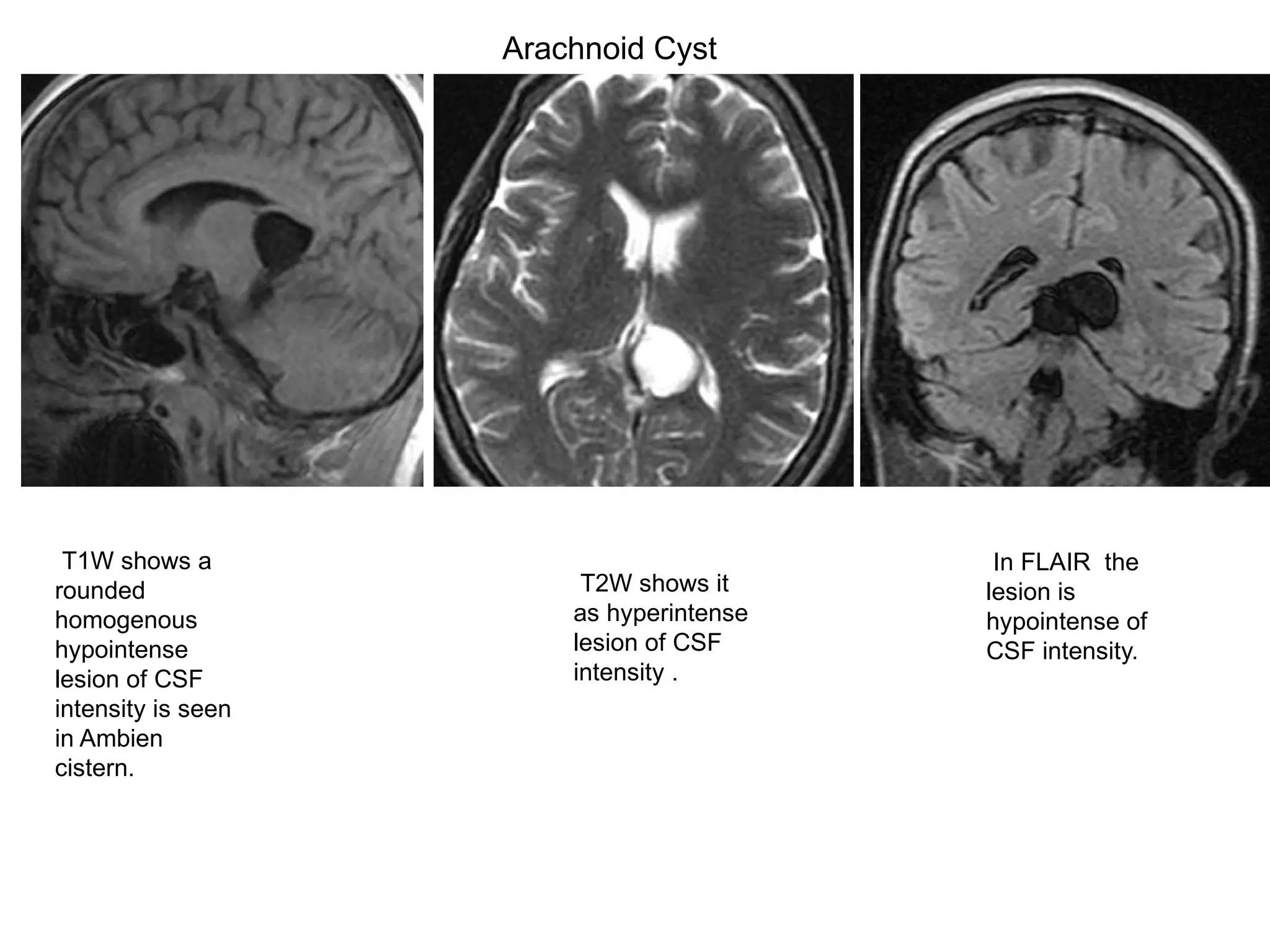 T1W shows a
rounded
homogenous
hypointense
lesion of CSF
intensity is seen
in Ambien
cistern.
Arachnoid Cyst
T2W shows it
as hyperintense
lesion of CSF
intensity .
In FLAIR the
lesion is
hypointense of
CSF intensity.
 