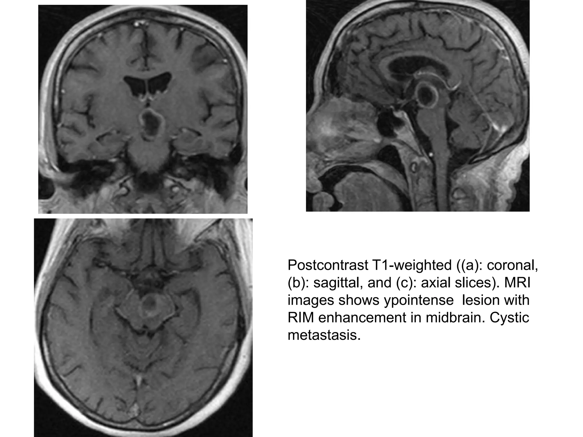 Postcontrast T1-weighted ((a): coronal,
(b): sagittal, and (c): axial slices). MRI
images shows ypointense lesion with
RIM enhancement in midbrain. Cystic
metastasis.
 