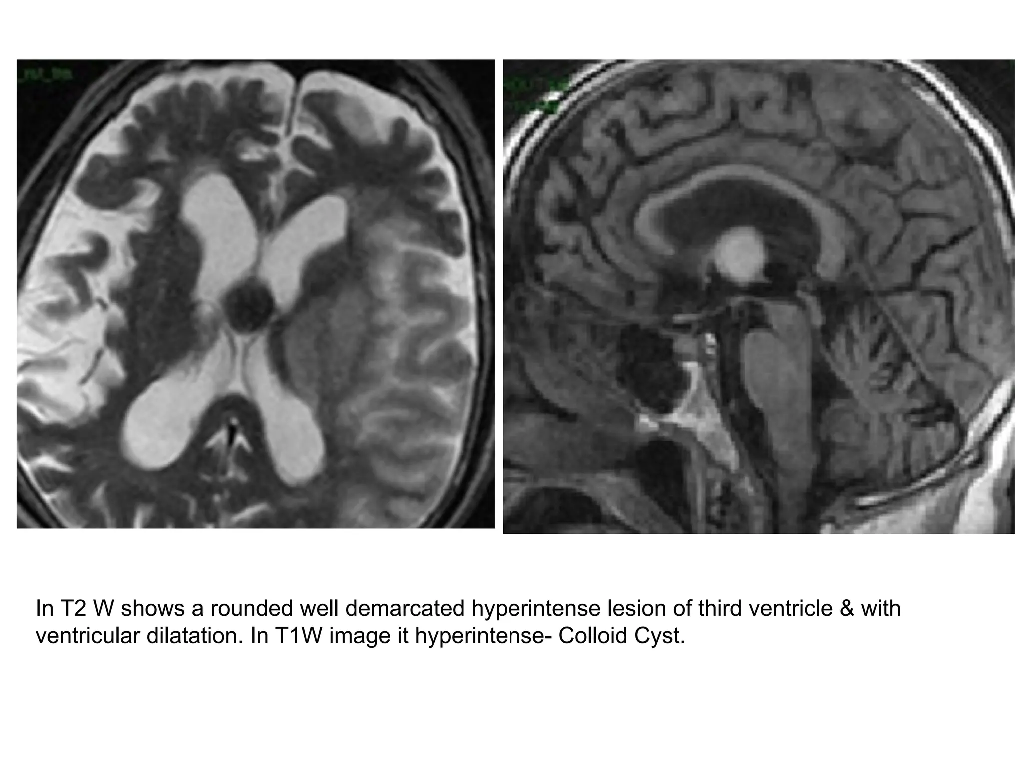 In T2 W shows a rounded well demarcated hyperintense lesion of third ventricle & with
ventricular dilatation. In T1W image it hyperintense- Colloid Cyst.
 