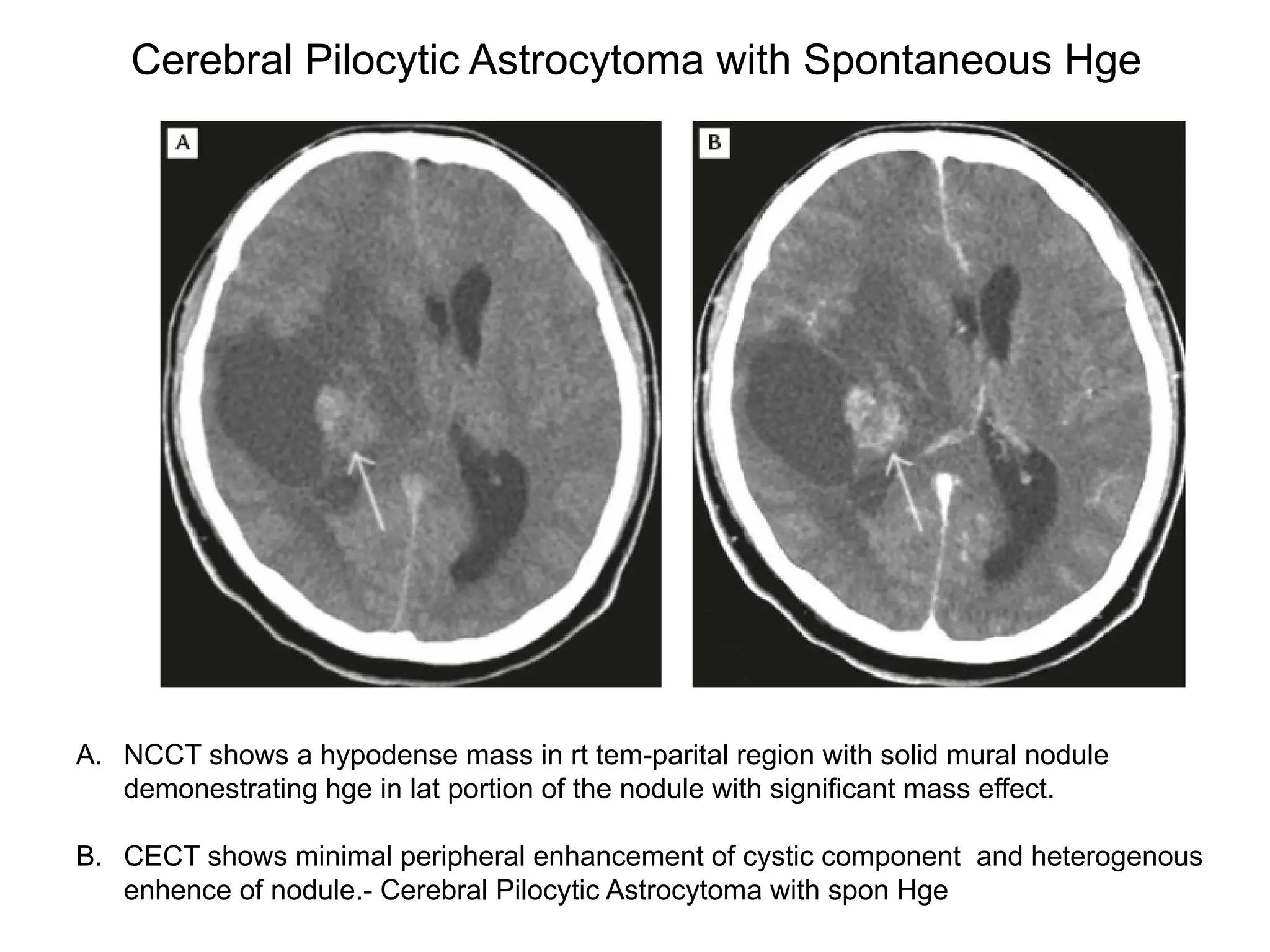 Cerebral Pilocytic Astrocytoma with Spontaneous Hge
A. NCCT shows a hypodense mass in rt tem-parital region with solid mural nodule
demonestrating hge in lat portion of the nodule with significant mass effect.
B. CECT shows minimal peripheral enhancement of cystic component and heterogenous
enhence of nodule.- Cerebral Pilocytic Astrocytoma with spon Hge
 