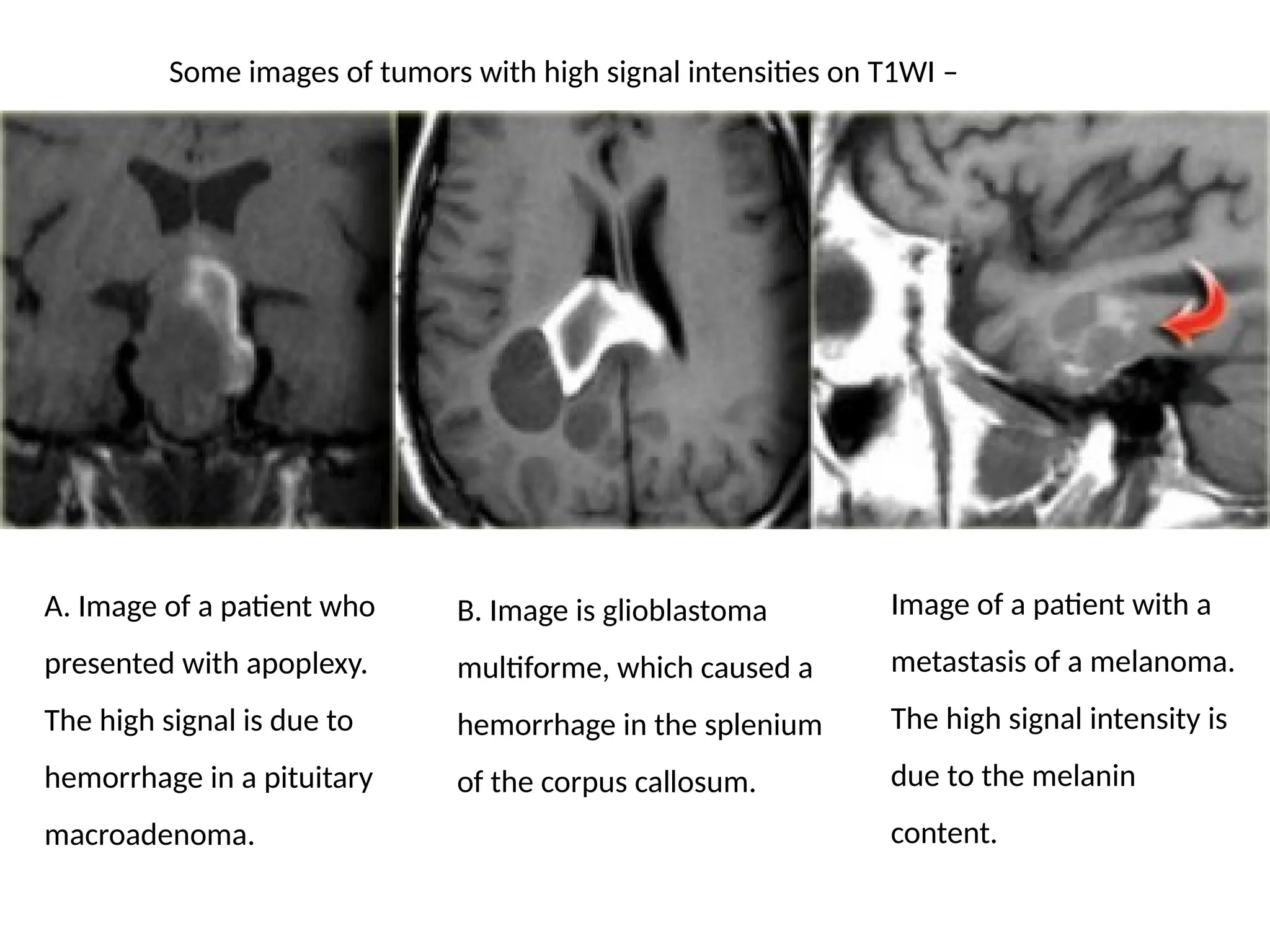 Image of a patient with a
metastasis of a melanoma.
The high signal intensity is
due to the melanin
content.
Some images of tumors with high signal intensities on T1WI –
A. Image of a patient who
presented with apoplexy.
The high signal is due to
hemorrhage in a pituitary
macroadenoma.
B. Image is glioblastoma
multiforme, which caused a
hemorrhage in the splenium
of the corpus callosum.
 