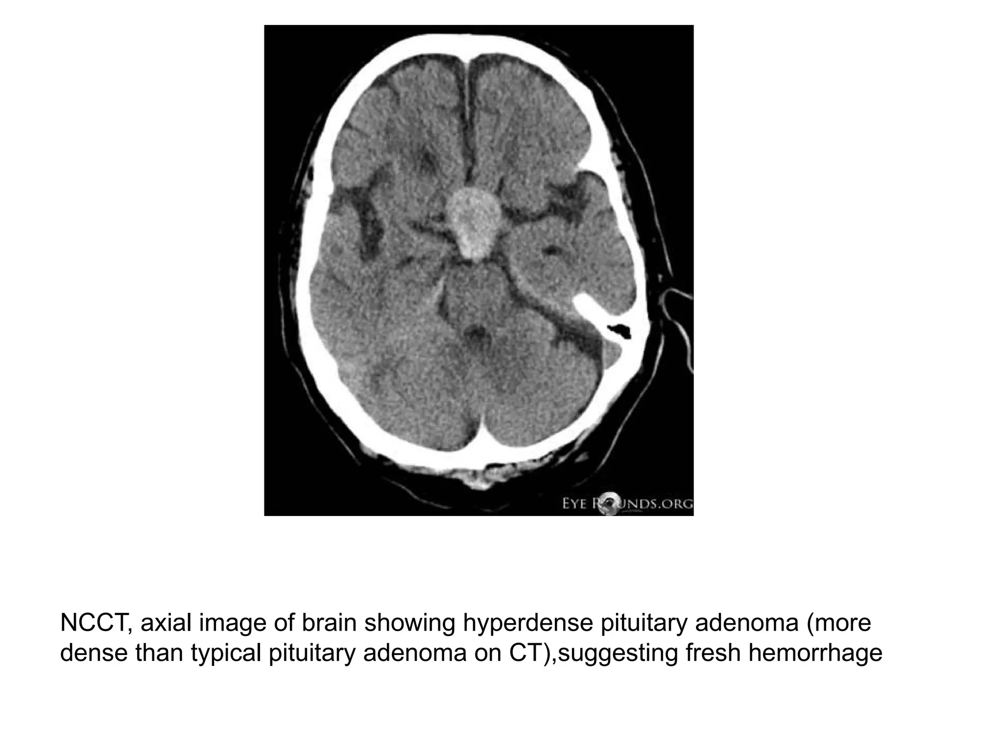NCCT, axial image of brain showing hyperdense pituitary adenoma (more
dense than typical pituitary adenoma on CT),suggesting fresh hemorrhage
 