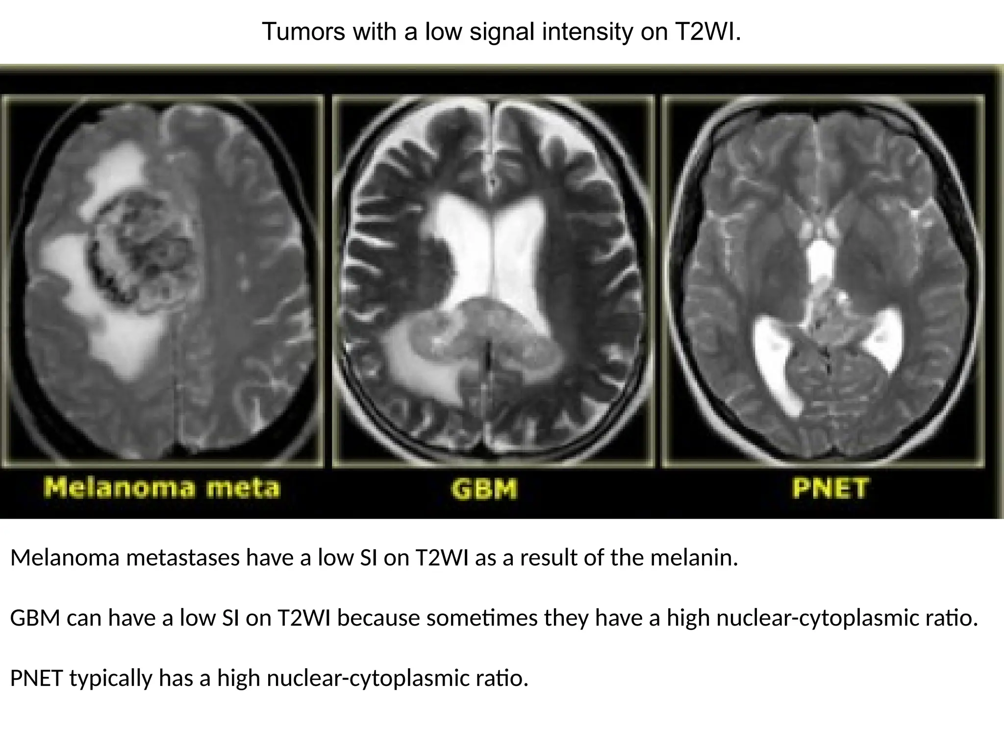Melanoma metastases have a low SI on T2WI as a result of the melanin.
GBM can have a low SI on T2WI because sometimes they have a high nuclear-cytoplasmic ratio.
PNET typically has a high nuclear-cytoplasmic ratio.
Tumors with a low signal intensity on T2WI.
 