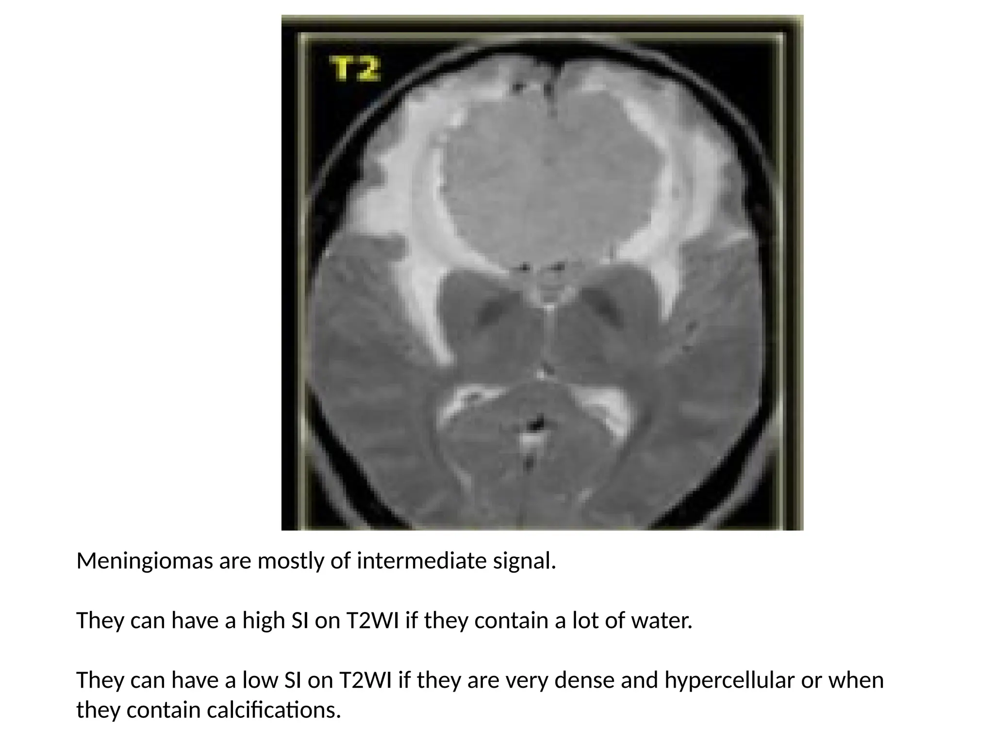 Meningiomas are mostly of intermediate signal.
They can have a high SI on T2WI if they contain a lot of water.
They can have a low SI on T2WI if they are very dense and hypercellular or when
they contain calcifications.
 