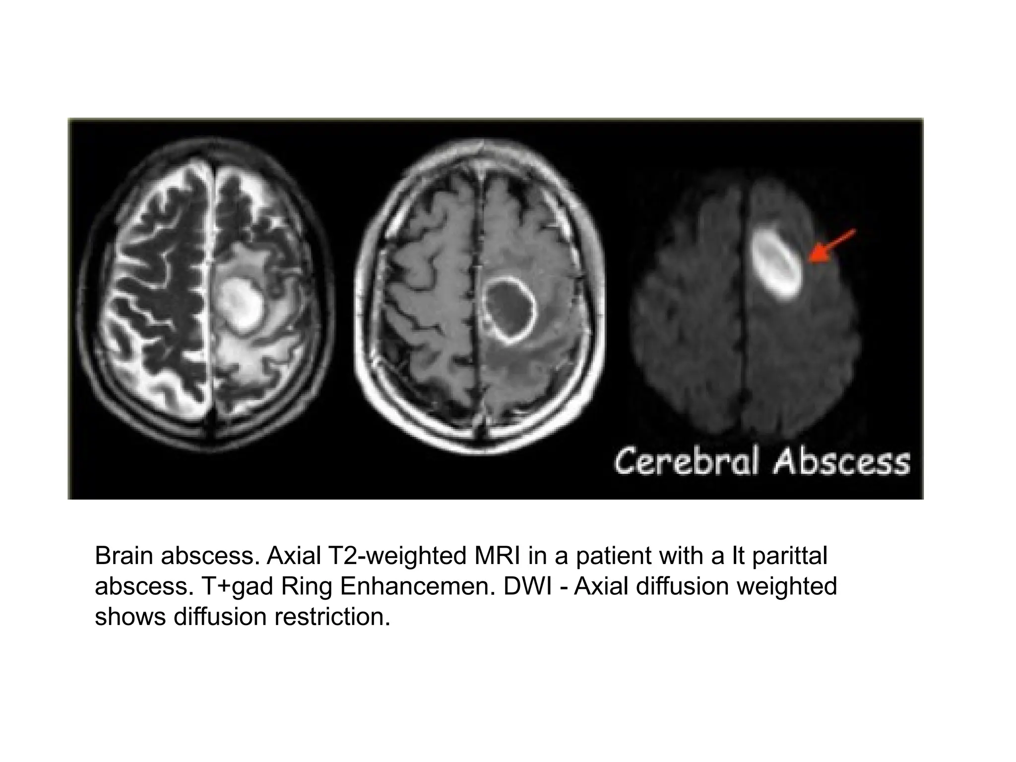 Brain abscess. Axial T2-weighted MRI in a patient with a lt parittal
abscess. T+gad Ring Enhancemen. DWI - Axial diffusion weighted
shows diffusion restriction.
 