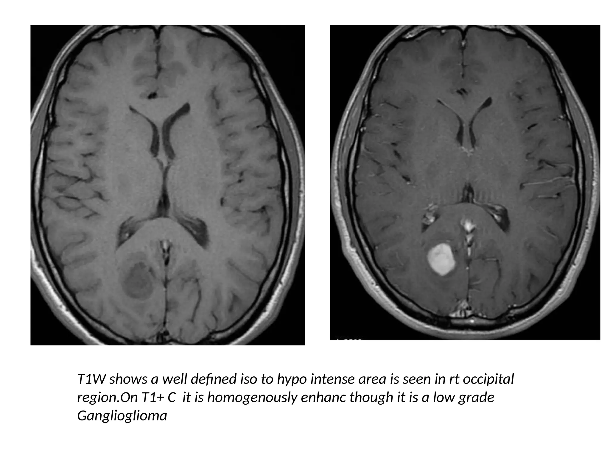 T1W shows a well defined iso to hypo intense area is seen in rt occipital
region.On T1+ C it is homogenously enhanc though it is a low grade
Ganglioglioma
 