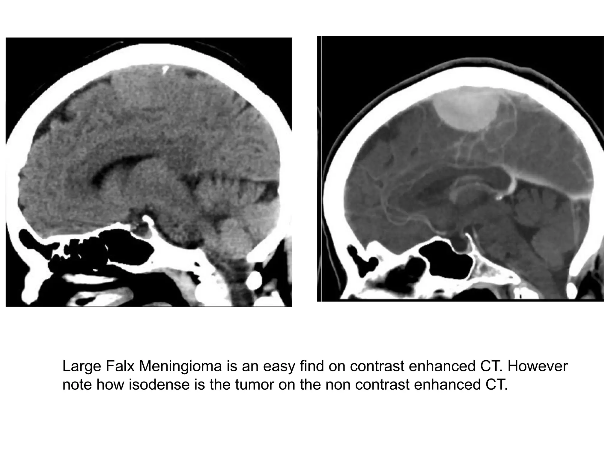 Large Falx Meningioma is an easy find on contrast enhanced CT. However
note how isodense is the tumor on the non contrast enhanced CT.
 