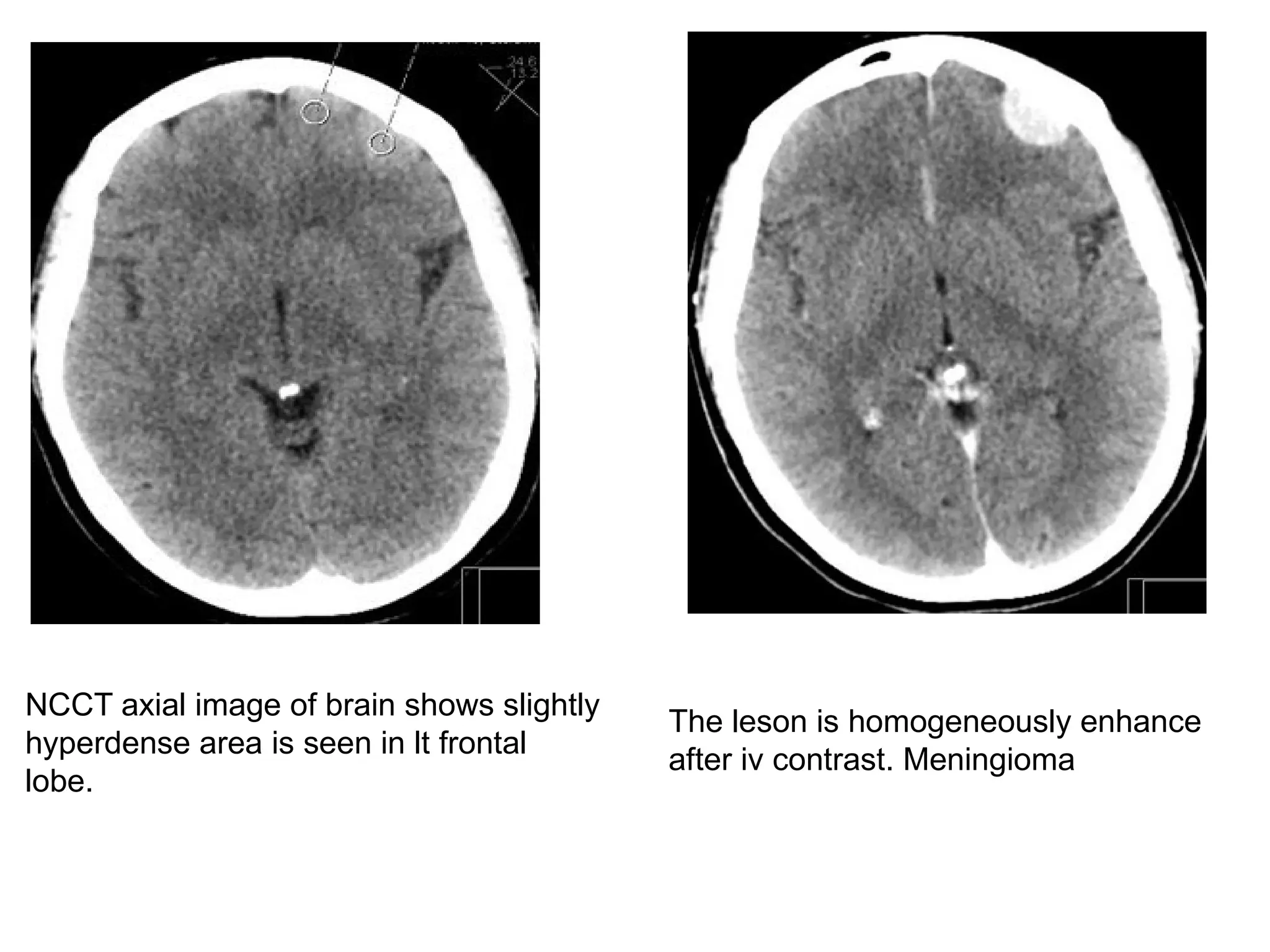 NCCT axial image of brain shows slightly
hyperdense area is seen in lt frontal
lobe.
The leson is homogeneously enhance
after iv contrast. Meningioma
 