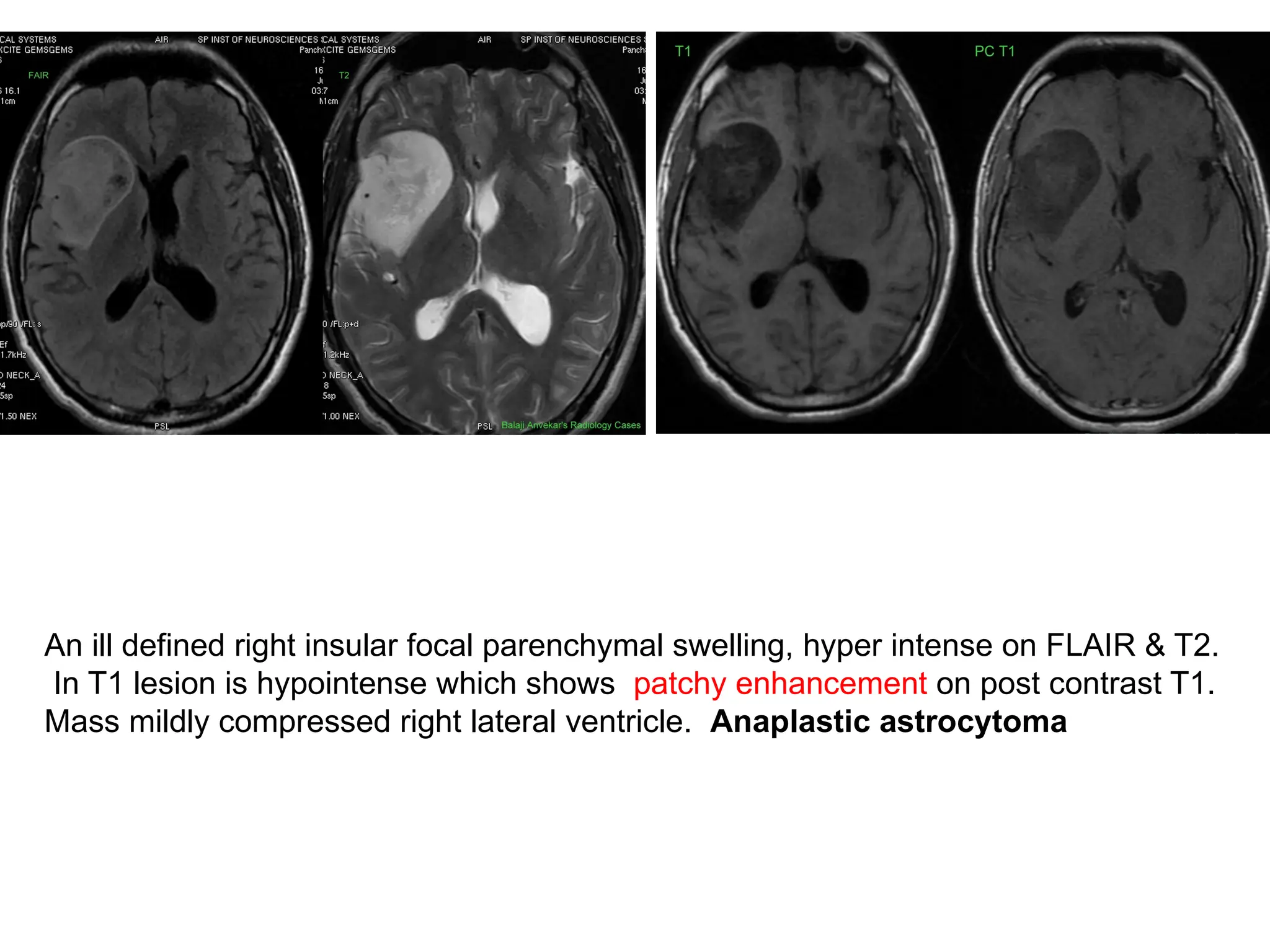 An ill defined right insular focal parenchymal swelling, hyper intense on FLAIR & T2.
In T1 lesion is hypointense which shows patchy enhancement on post contrast T1.
Mass mildly compressed right lateral ventricle. Anaplastic astrocytoma
 