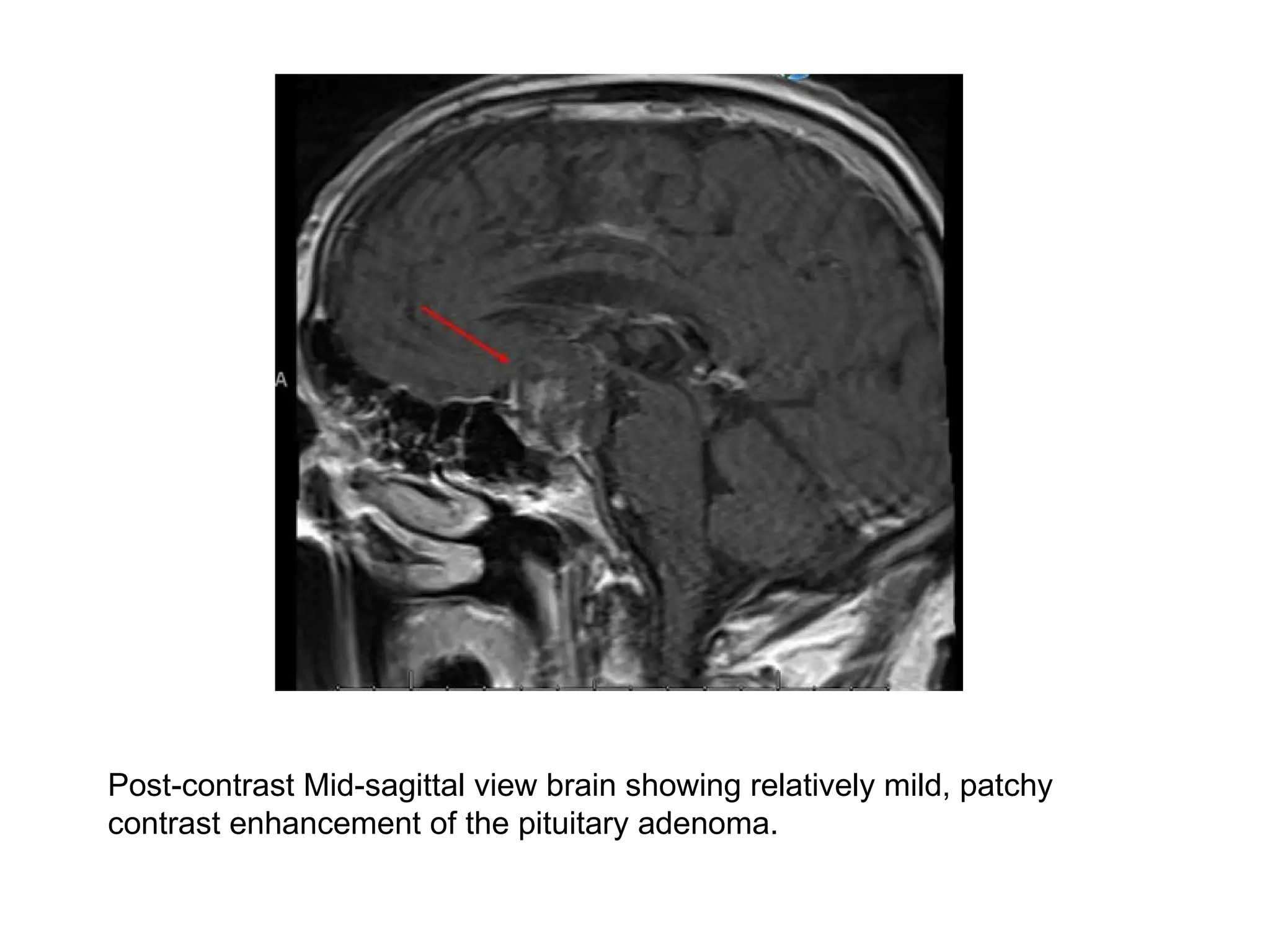 Post-contrast Mid-sagittal view brain showing relatively mild, patchy
contrast enhancement of the pituitary adenoma.
 