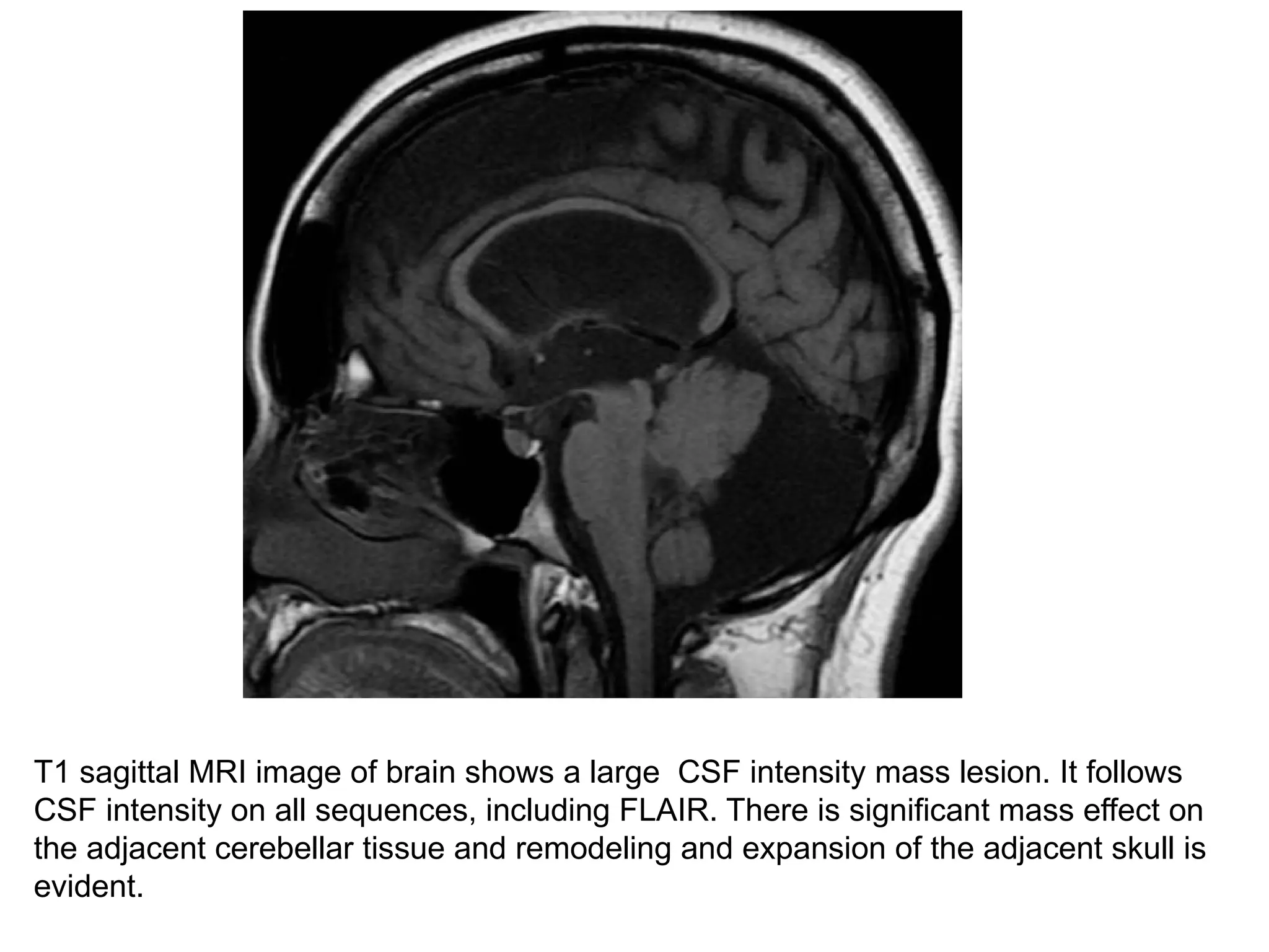 T1 sagittal MRI image of brain shows a large CSF intensity mass lesion. It follows
CSF intensity on all sequences, including FLAIR. There is significant mass effect on
the adjacent cerebellar tissue and remodeling and expansion of the adjacent skull is
evident.
 