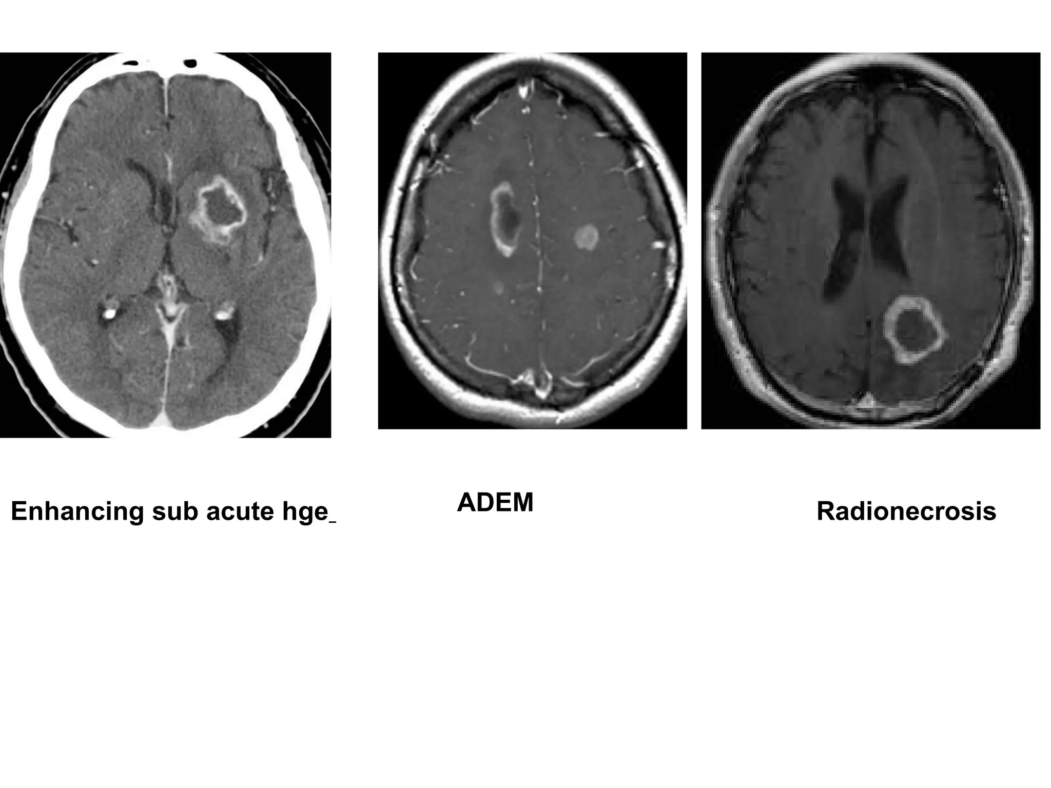 Enhancing sub acute hge ADEM Radionecrosis
 