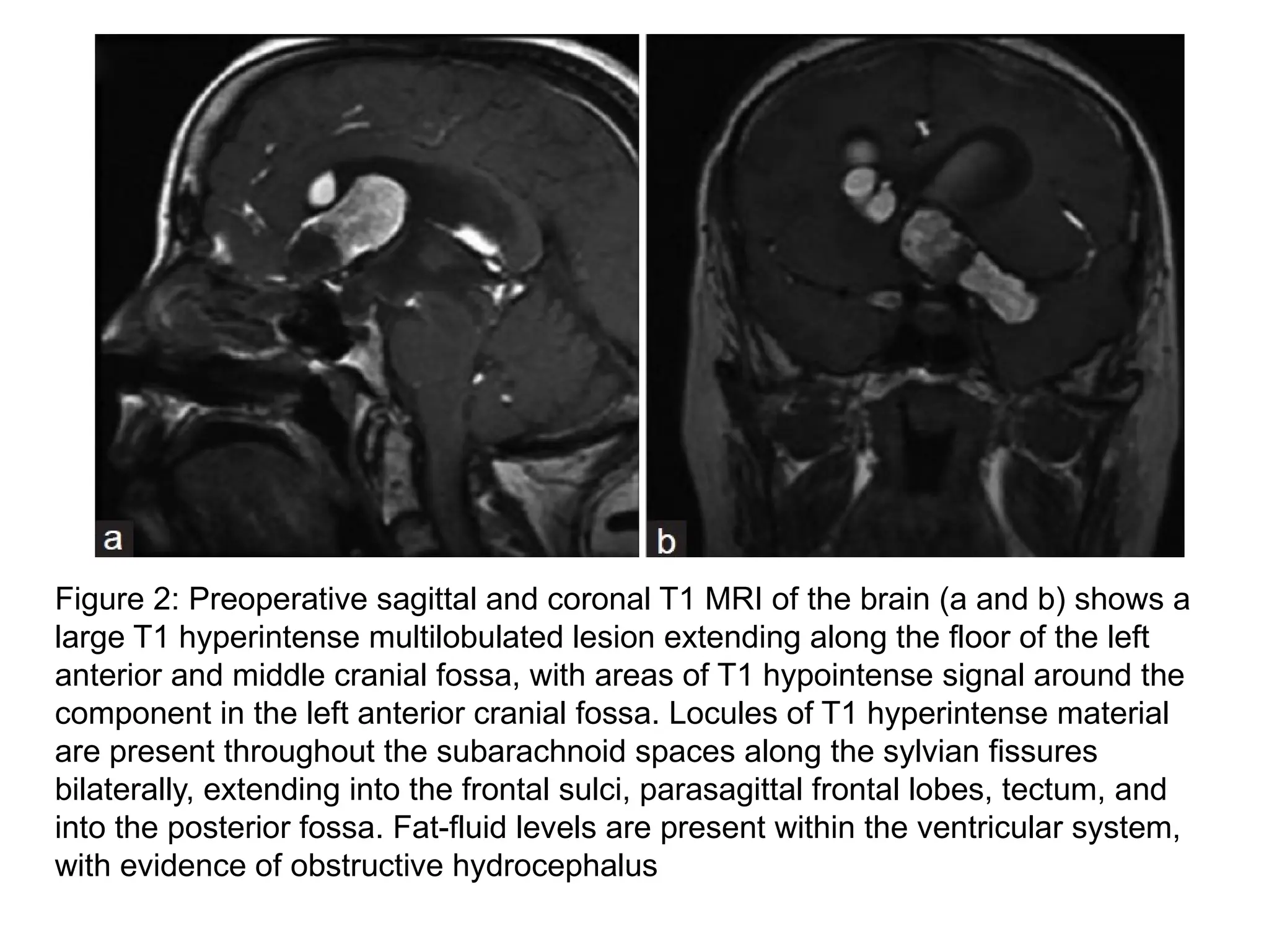 Figure 2: Preoperative sagittal and coronal T1 MRI of the brain (a and b) shows a
large T1 hyperintense multilobulated lesion extending along the floor of the left
anterior and middle cranial fossa, with areas of T1 hypointense signal around the
component in the left anterior cranial fossa. Locules of T1 hyperintense material
are present throughout the subarachnoid spaces along the sylvian fissures
bilaterally, extending into the frontal sulci, parasagittal frontal lobes, tectum, and
into the posterior fossa. Fat-fluid levels are present within the ventricular system,
with evidence of obstructive hydrocephalus
 