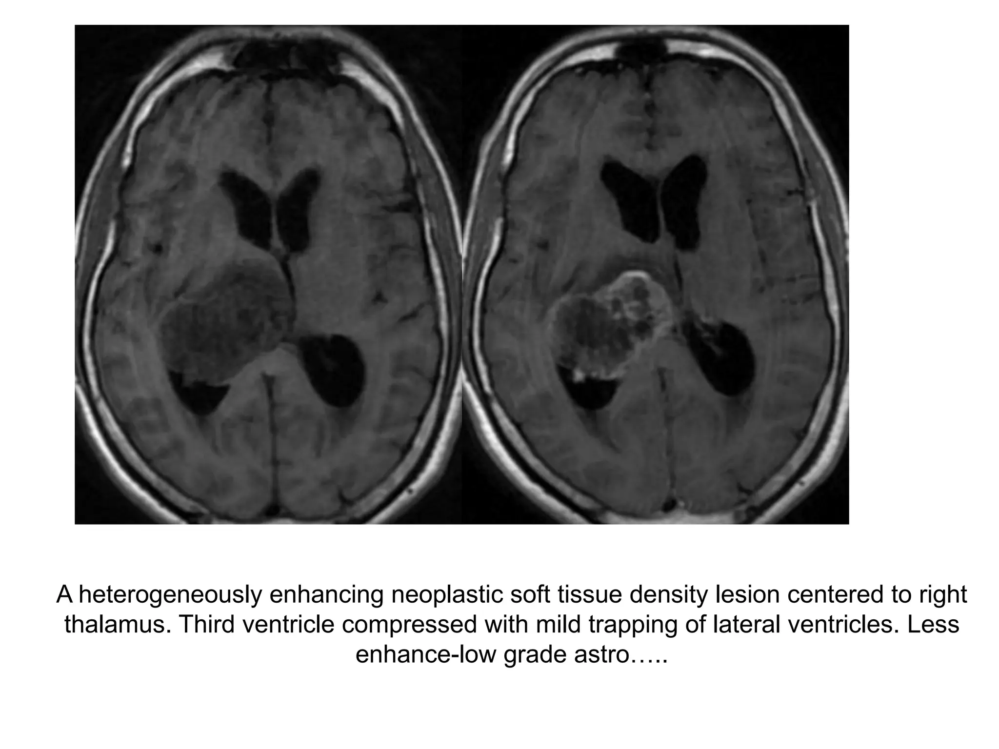 A heterogeneously enhancing neoplastic soft tissue density lesion centered to right
thalamus. Third ventricle compressed with mild trapping of lateral ventricles. Less
enhance-low grade astro…..
 