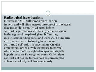 Radiological investigations
CT scan and MRI will show a pineal region
tumour and will often suggest the correct pathological
diagnosis (Fig. 6.13). On CT scan, before
contrast, a germinoma will be a hyperdense lesion
in the region of the pineal gland infiltrating
into the surrounding tissue and there will be uniform
vivid enhancement following intravenous
contrast. Calcification is uncommon. On MRI
germinomas are relatively isointense to normal
white matter on T1-weighted images and slightly
hyperintense on T2-weighted scans. Gadolinium
contrast defines the tumour well as germinomas
enhance markedly and homogeneously
 