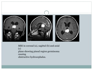 MRI in coronal (a), sagittal (b) and axial
(c)
plane showing pineal region germinoma
causing
obstructive hydrocephalus.
 