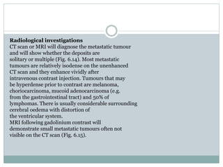 Radiological investigations
CT scan or MRI will diagnose the metastatic tumour
and will show whether the deposits are
solitary or multiple (Fig. 6.14). Most metastatic
tumours are relatively isodense on the unenhanced
CT scan and they enhance vividly after
intravenous contrast injection. Tumours that may
be hyperdense prior to contrast are melanoma,
choriocarcinoma, mucoid adenocarcinoma (e.g.
from the gastrointestinal tract) and 50% of
lymphomas. There is usually considerable surrounding
cerebral oedema with distortion of
the ventricular system.
MRI following gadolinium contrast will
demonstrate small metastatic tumours often not
visible on the CT scan (Fig. 6.15).
 