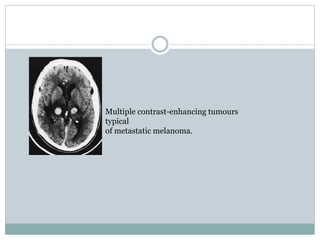 Multiple contrast-enhancing tumours
typical
of metastatic melanoma.
 