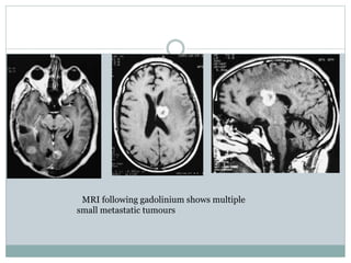 MRI following gadolinium shows multiple
small metastatic tumours
 
