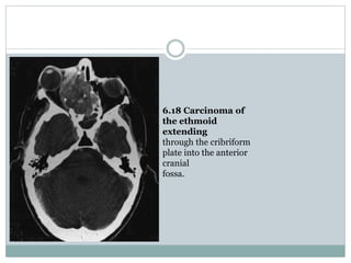 6.18 Carcinoma of
the ethmoid
extending
through the cribriform
plate into the anterior
cranial
fossa.
 