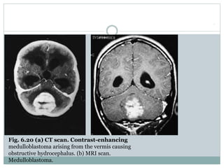 .
Fig. 6.20 (a) CT scan. Contrast-enhancing
medulloblastoma arising from the vermis causing
obstructive hydrocephalus. (b) MRI scan.
Medulloblastoma.
 