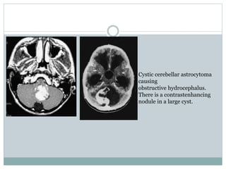 Cystic cerebellar astrocytoma
causing
obstructive hydrocephalus.
There is a contrastenhancing
nodule in a large cyst.
 