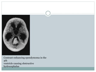 Contrast-enhancing ependymoma in the
4th
ventricle causing obstructive
hydrocephalus
 