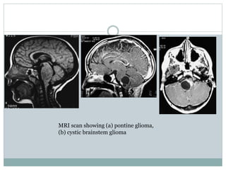 MRI scan showing (a) pontine glioma,
(b) cystic brainstem glioma
 