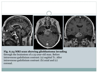 Fig. 6.24 MRI scan showing glioblastoma invading
through the brainstem of a 25-year-old man. Before
intravenous gadolinium contrast: (a) sagittal T1. After
intravenous gadolinium contrast: (b) axial and (c)
coronal.
 