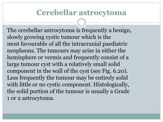 Cerebellar astrocytoma
The cerebellar astrocytoma is frequently a benign,
slowly growing cystic tumour which is the
most favourable of all the intracranial paediatric
neoplasms. The tumours may arise in either the
hemisphere or vermis and frequently consist of a
large tumour cyst with a relatively small solid
component in the wall of the cyst (see Fig. 6.20).
Less frequently the tumour may be entirely solid
with little or no cystic component. Histologically,
the solid portion of the tumour is usually a Grade
1 or 2 astrocytoma.
 