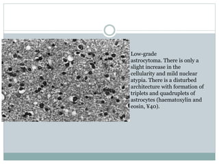 Low-grade
astrocytoma. There is only a
slight increase in the
cellularity and mild nuclear
atypia. There is a disturbed
architecture with formation of
triplets and quadruplets of
astrocytes (haematoxylin and
eosin, ¥40).
 