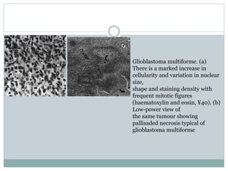Glioblastoma multiforme. (a)
There is a marked increase in
cellularity and variation in nuclear
size,
shape and staining density with
frequent mitotic figures
(haematoxylin and eosin, ¥40). (b)
Low-power view of
the same tumour showing
pallisaded necrosis typical of
glioblastoma multiforme
 